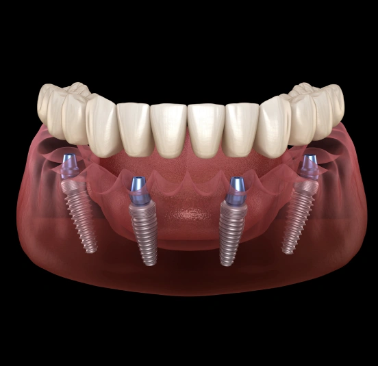 Replace One Missing Tooth With a Permanent Solution