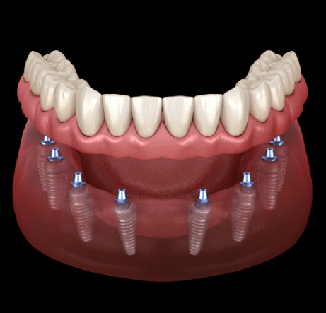 Replace One Missing Tooth With a Permanent Solution