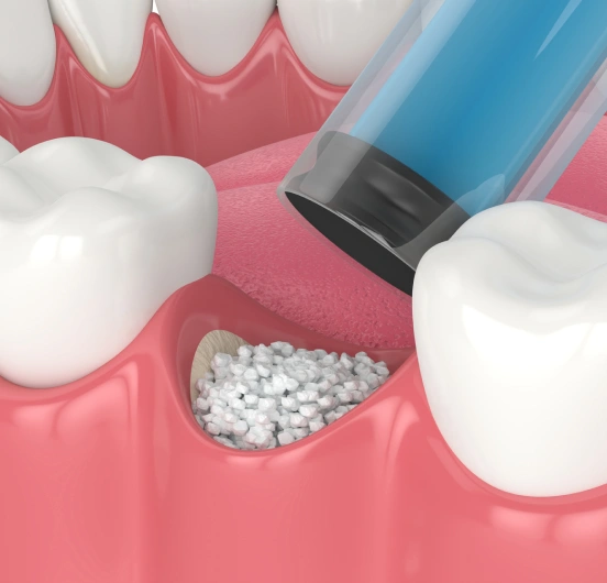 Rebuilding the Foundation Your Smile Needs