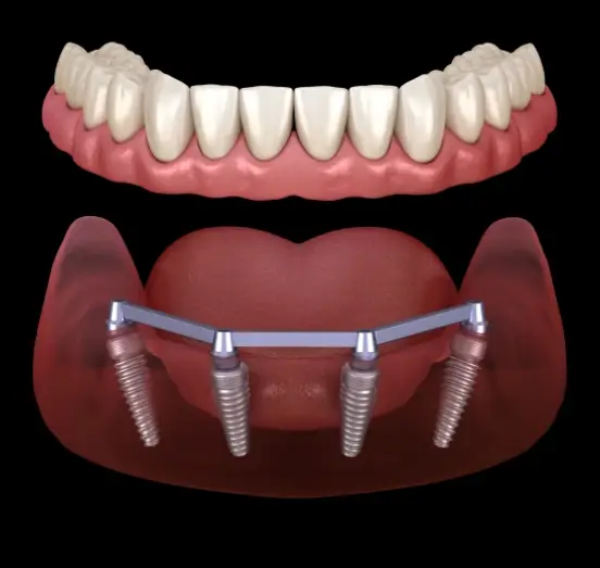 Replace One Missing Tooth With a Permanent Solution