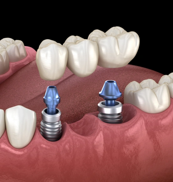 Replace One Missing Tooth With a Permanent Solution