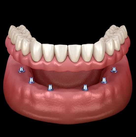 Replace One Missing Tooth With a Permanent Solution