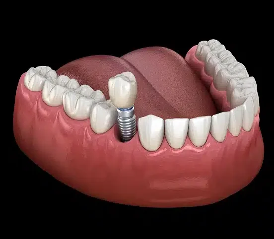 Replace One Missing Tooth With a Permanent Solution