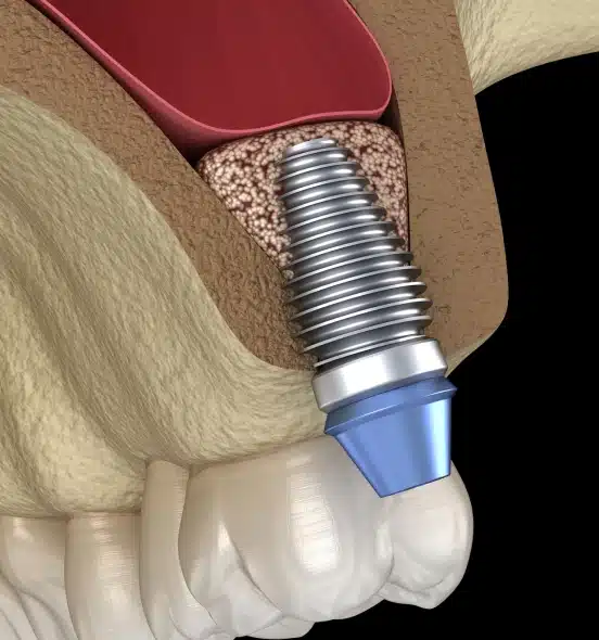 Replace One Missing Tooth With a Permanent Solution
