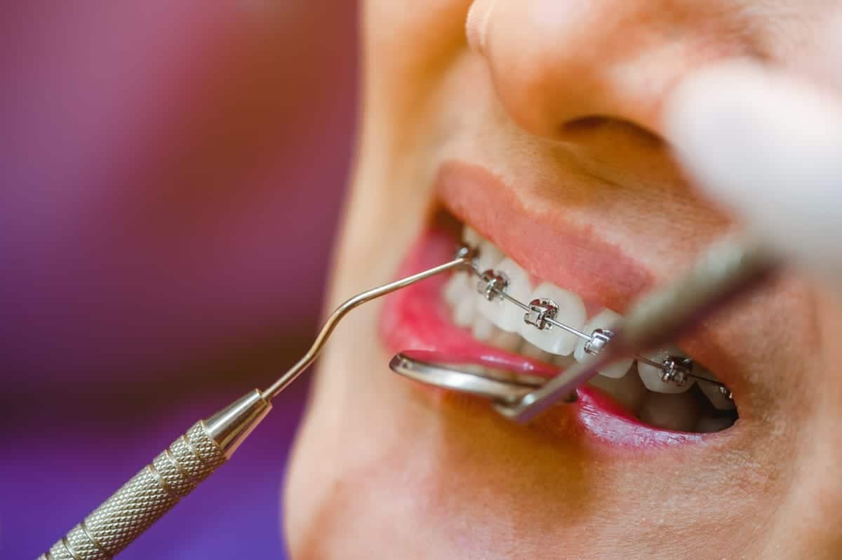 Dental Bridges in Grosse Pointe Woods